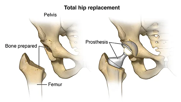 Detailed anatomical diagram showing normal hip joint anatomy versus total hip replacement components