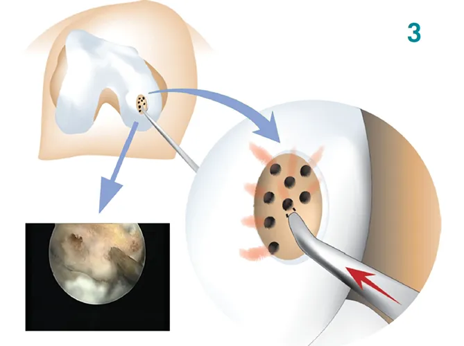 Arthroscopic cartilage restoration showing microfracture technique