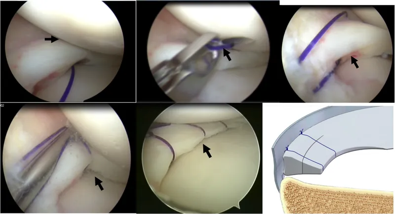 Arthroscopic meniscal repair showing suture placement and tissue approximation