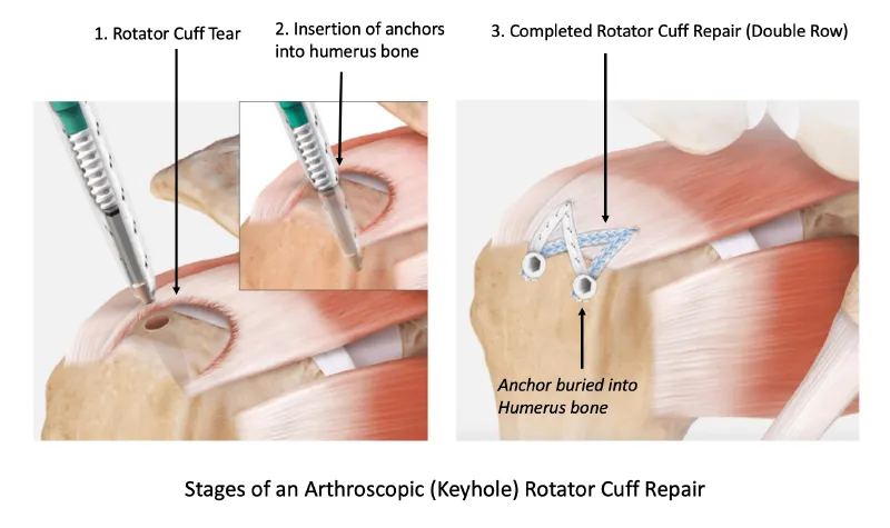Arthroscopic rotator cuff repair showing double-row suture anchor technique