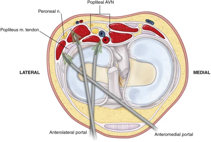 Anatomical diagram showing standard knee arthroscopy portal placement with safety zones