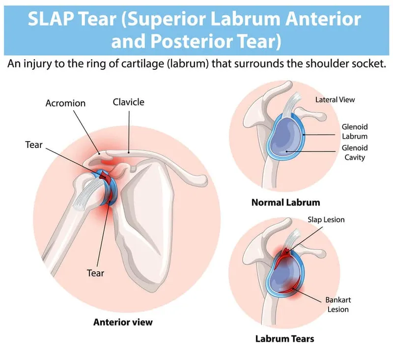 Arthroscopic view of shoulder showing labral tear and cartilage damage