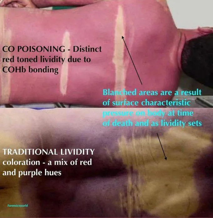 carbon monoxide poisoning cherry red