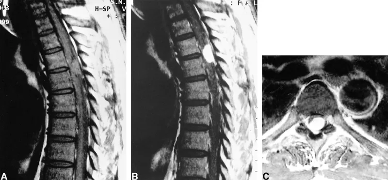 Figure 1: MRI showing cauda equina compression with nerve root clumping