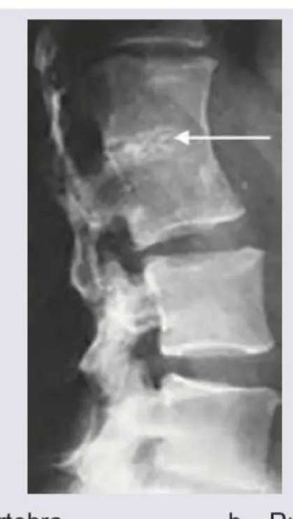 Figure 2: Spinal X-ray showing vertebral compression fracture with wedging