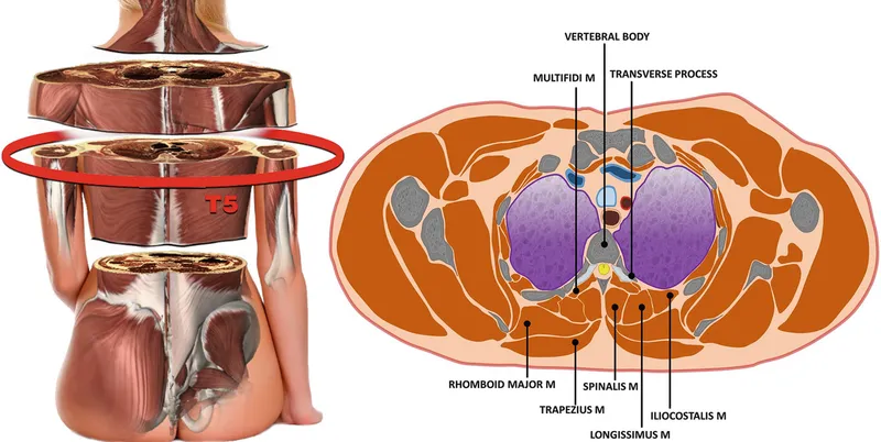 Cross-sectional view of deep back muscles showing erector spinae components