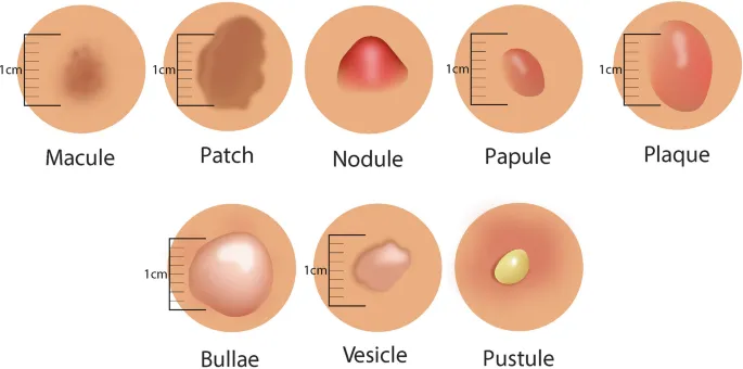 Clinical examples of primary skin lesions with measurement scales