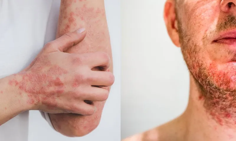 Comparative clinical images of psoriasis versus seborrheic dermatitis
