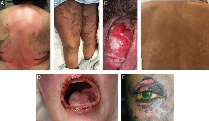 Clinical images of dermatological emergencies requiring immediate recognition