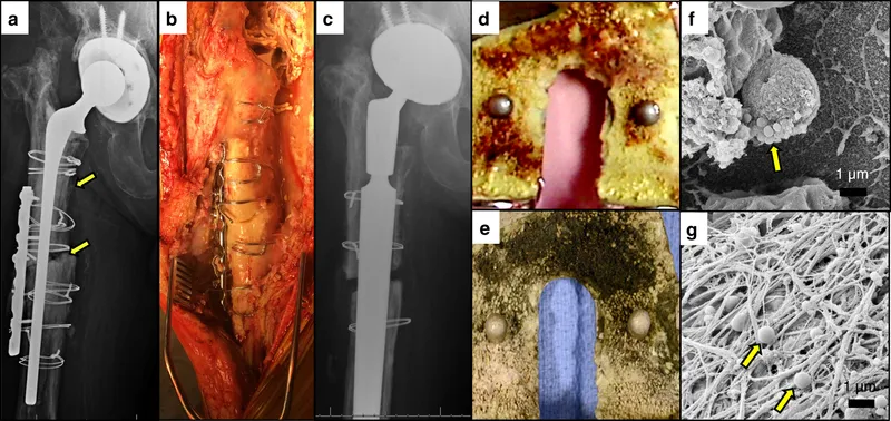 MRI image showing chronic osteomyelitis with biofilm-associated bone changes