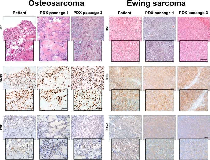 Comparative histology showing osteosarcoma versus Ewing sarcoma cellular morphology