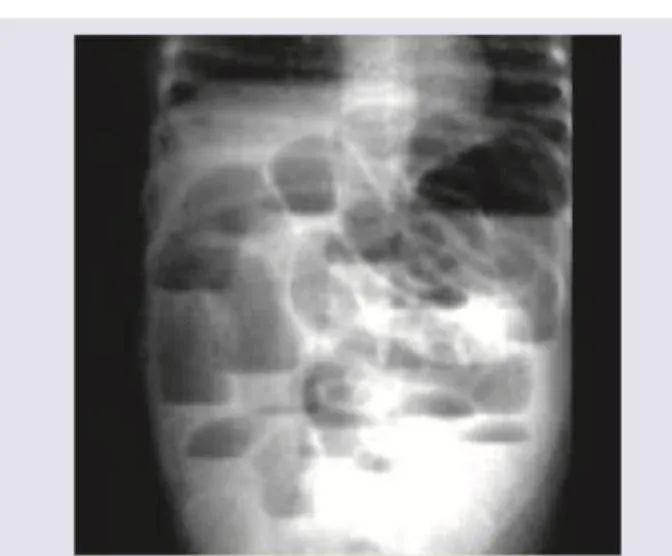 Figure 1: Abdominal X-ray showing dilated small bowel loops with valvulae conniventes crossing entire width and paucity of gas in colon