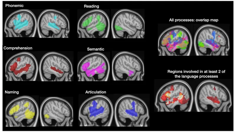 Brain imaging showing language areas in left hemisphere