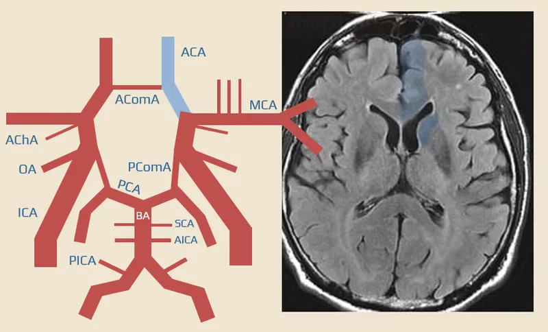Brain MRI showing stroke lesion with corresponding deficit pattern