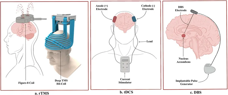 Brain stimulation techniques showing TMS and DBS targeting