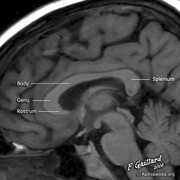 Corpus callosum sagittal view showing anatomical divisions