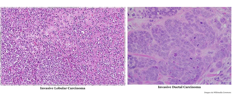 Histological comparison of different breast cancer subtypes