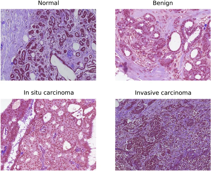 Comparative histological images showing benign vs malignant breast tissue