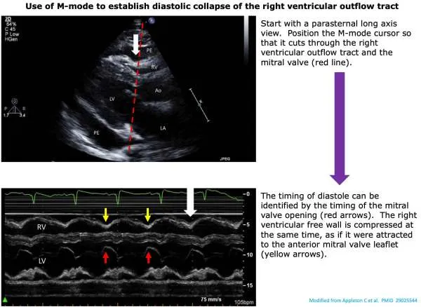 Echocardiogram showing pericardial effusion with cardiac tamponade