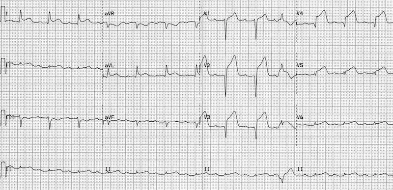 Figure 3: ECG showing ST segment elevation greater than 2mm in leads V1 to V4 consistent with anterior STEMI