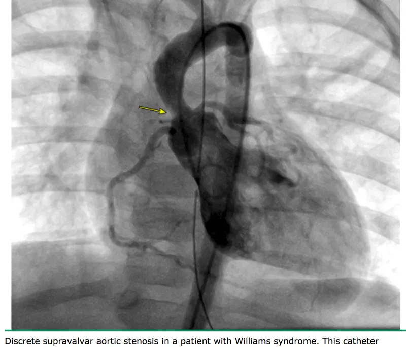 aortic stenosis pressure tracing