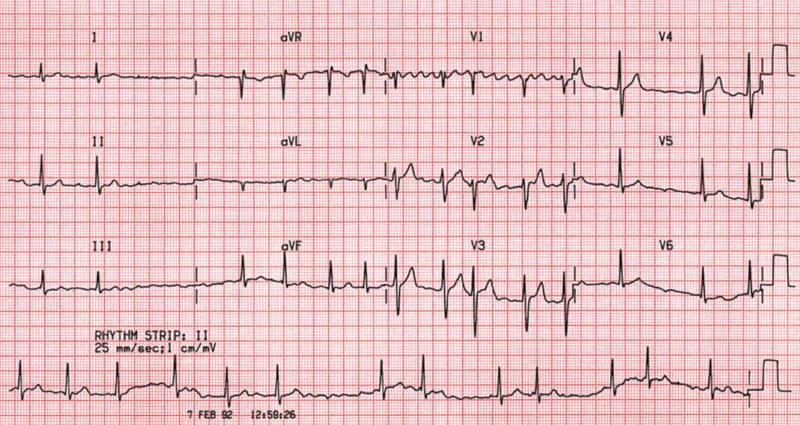 Figure 1: ECG showing irregularly irregular rhythm with absent P waves and variable RR intervals diagnostic of atrial fibrillation