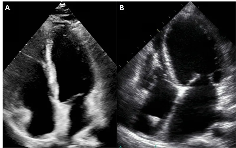 Figure 4: Transthoracic echocardiogram apical four chamber view showing dilated left ventricle with reduced ejection fraction
