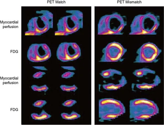 PET perfusion metabolism mismatch patterns