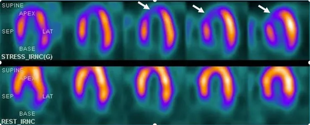 Nuclear SPECT perfusion imaging defects