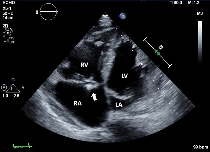 Transthoracic echocardiogram four chamber view