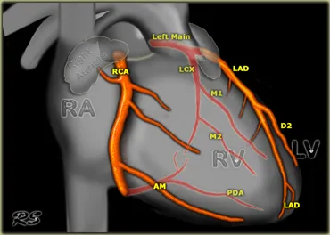 Coronary angiogram showing normal coronary artery anatomy and circulation