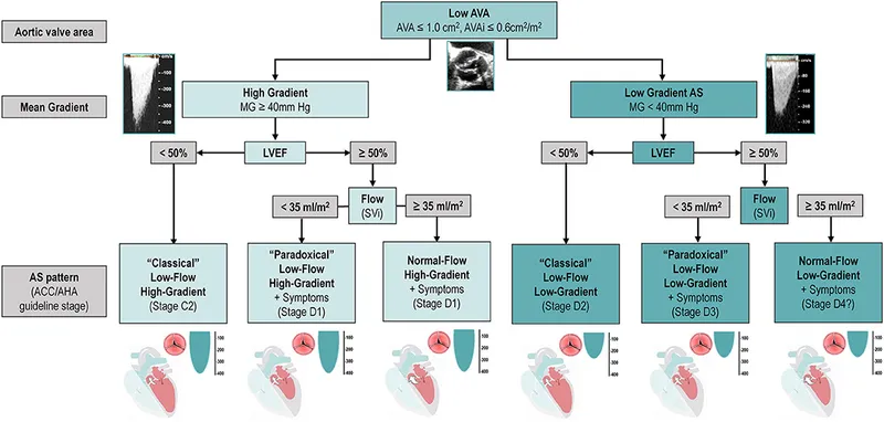 Doppler echocardiogram showing severe aortic stenosis with pressure gradient