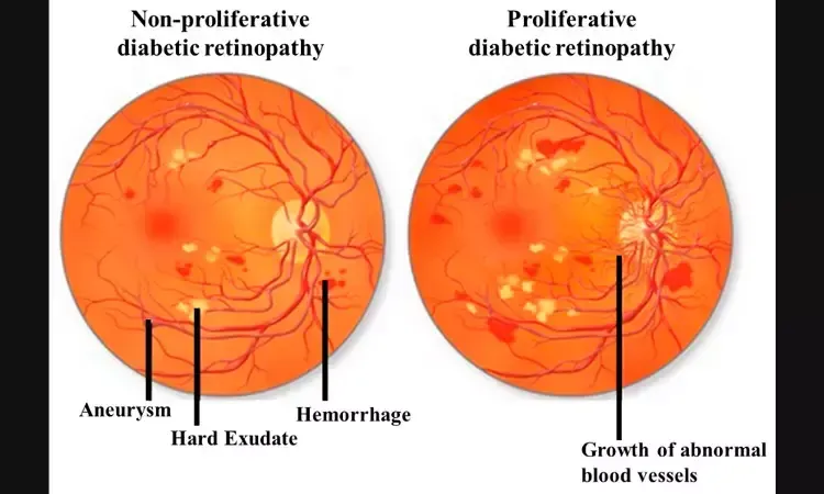 Figure 1: Fundoscopy showing early diabetic retinopathy with microaneurysms and dot hemorrhages