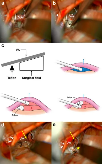 Surgical anatomy of cranial nerve decompression procedures