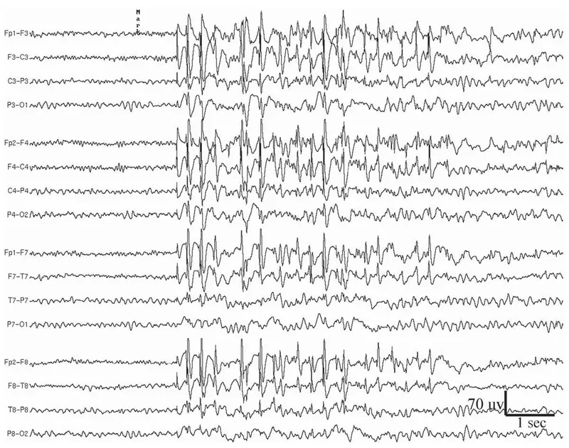 EEG recording showing different seizure patterns and their characteristic waveforms