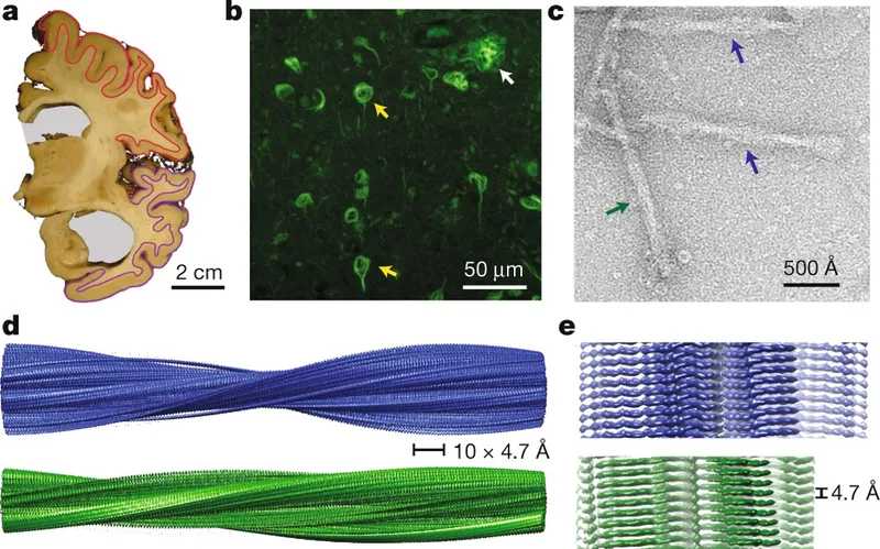 Electron microscopy showing amyloid plaques and neurofibrillary tangles