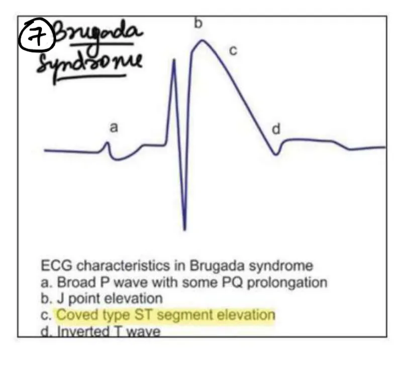 Figure 2: ECG showing coved ST elevation in V1-V2 characteristic of Type 1 Brugada pattern