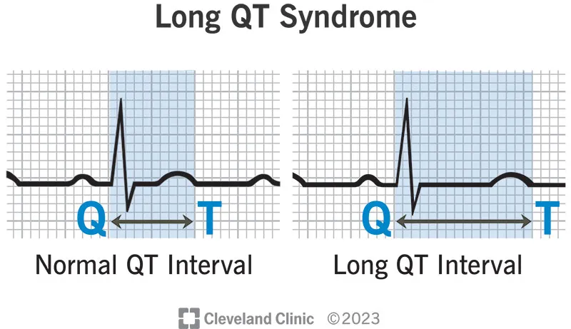 Figure 1: ECG showing prolonged QT interval exceeding half the RR interval