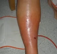 Figure 1: Clinical photograph showing unilateral erythema and oedema with well-demarcated border characteristic of lower limb cellulitis
