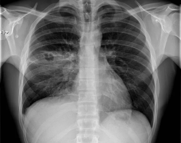 Figure 2: Chest X-ray showing bilateral patchy consolidation in patient with Staphylococcus aureus bacteraemia secondary to cellulitis