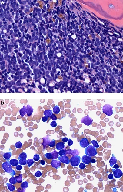 Bone marrow aspirate showing lymphoblasts in pediatric ALL