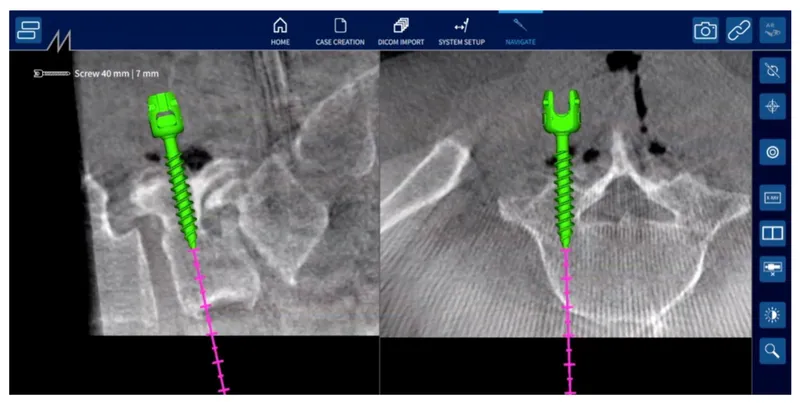 Computer-assisted spine surgery with pedicle screw placement
