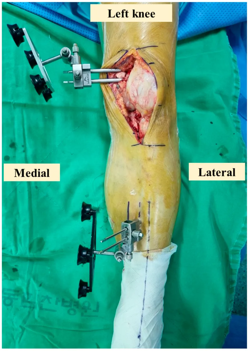 Computer-assisted total knee replacement surgery in progress