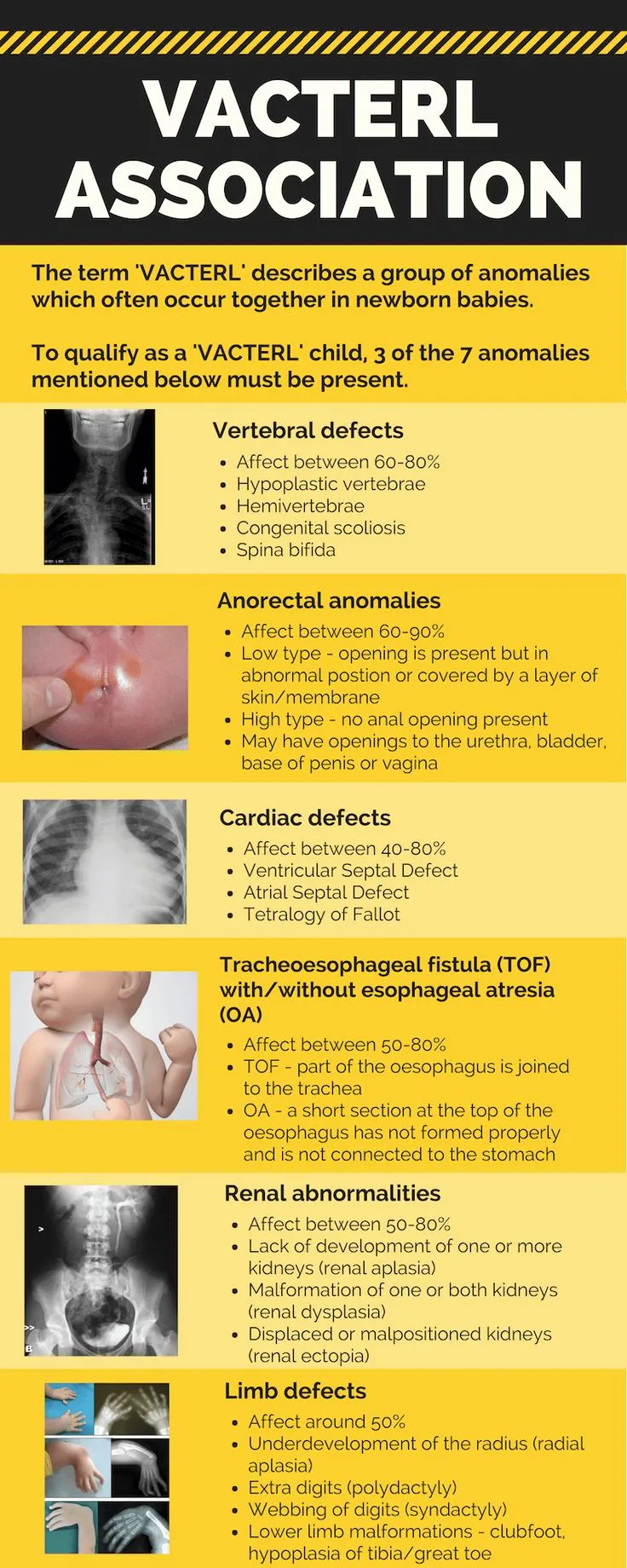 VACTERL association showing multiple organ system involvement