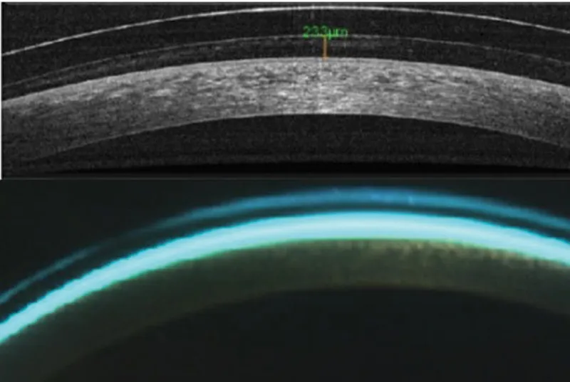 Anterior segment OCT image showing contact lens position and corneal clearance