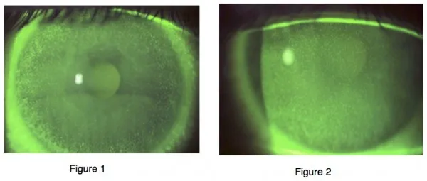 Corneal fluorescein staining patterns showing different types of contact lens complications