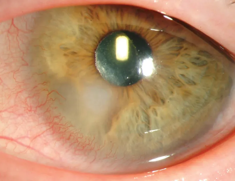 Slit lamp photograph showing corneal neovascularization from contact lens hypoxia