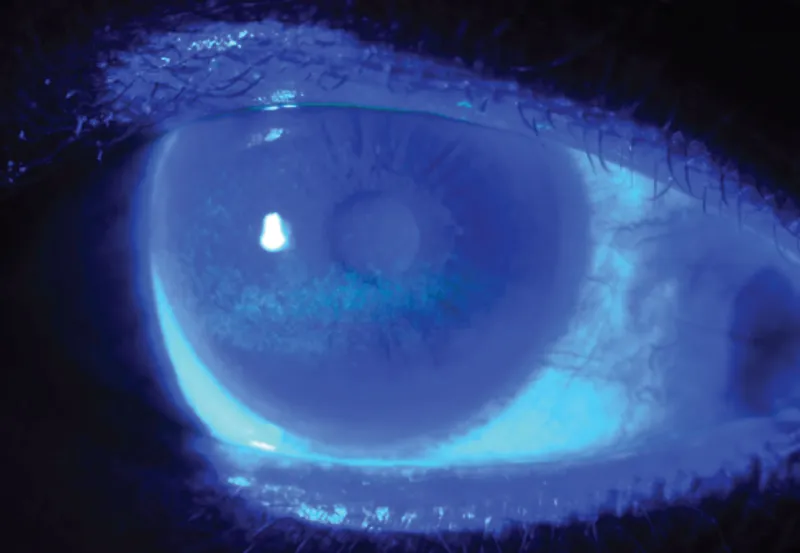 Slit lamp biomicroscopy image showing contact lens assessment with fluorescein staining