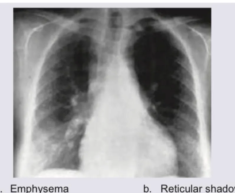 Figure 2: Chest X-ray showing hyperinflated lungs with flattened hemidiaphragms