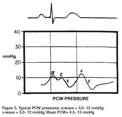 Pulmonary artery catheter waveform interpretation guide